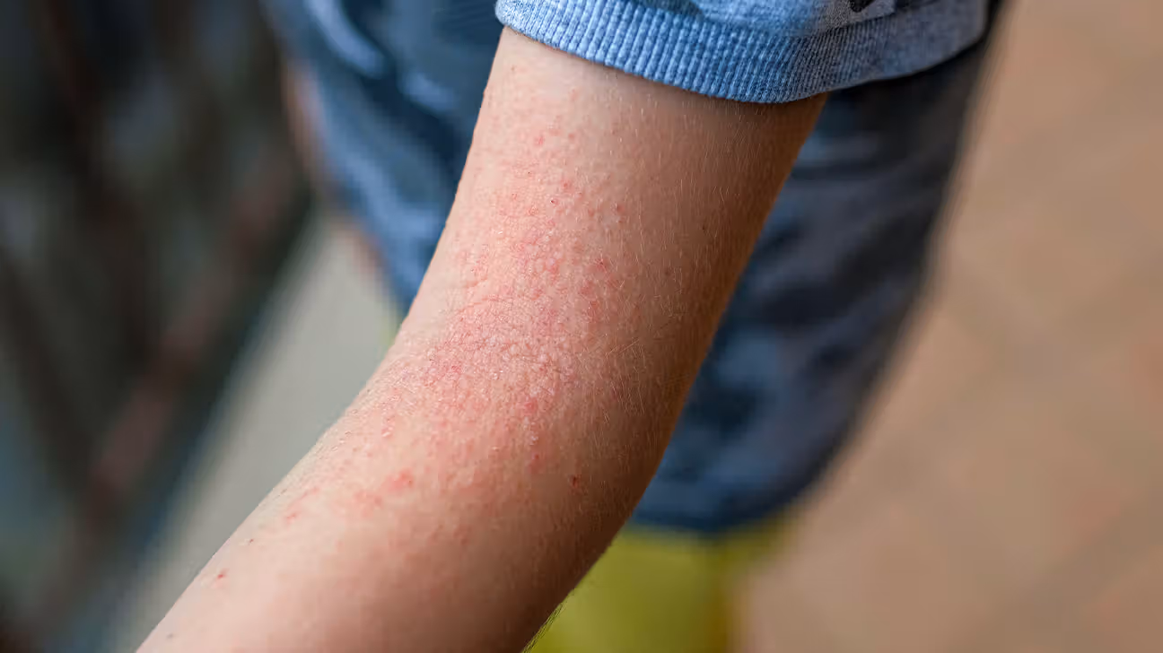 Atopic Dermatitis