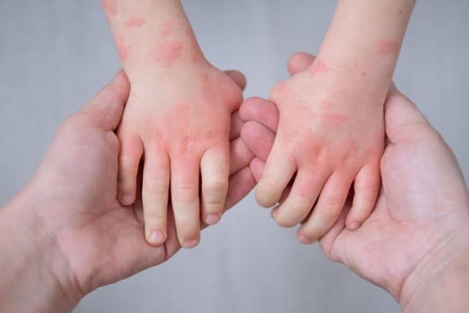 food allergy